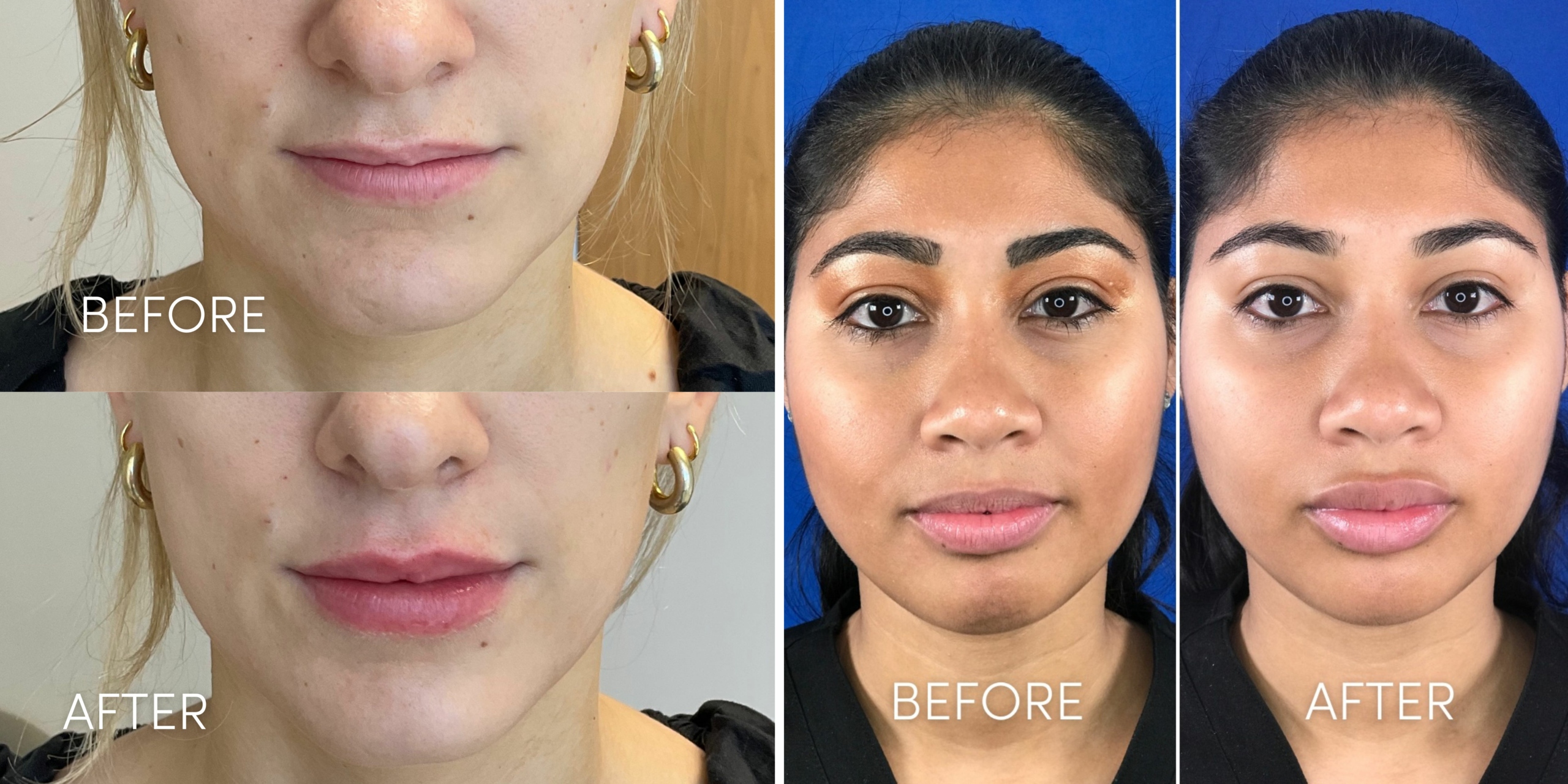 Techniques in Cupid's Bow Reshaping of the Upper Lip - Explore Plastic  Surgery