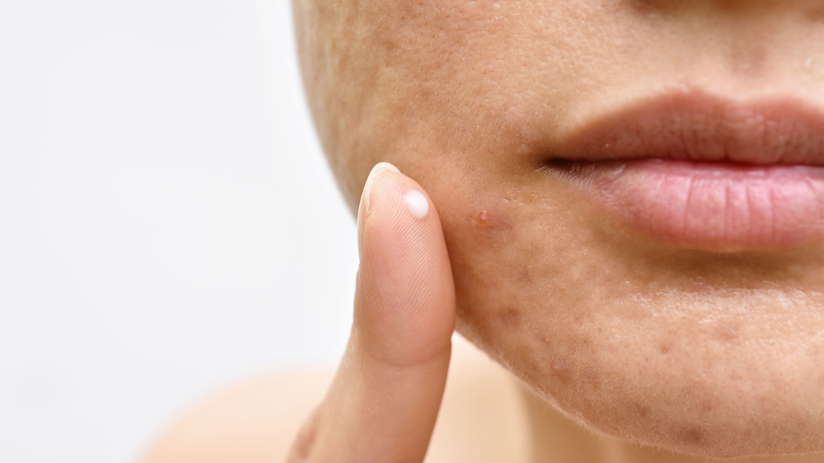 Ultimate Guide to Acne and Scarring Treatment