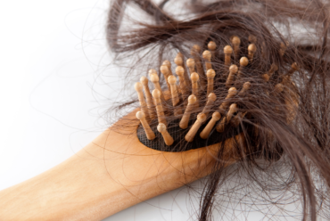 Hair loss conditions and treatments