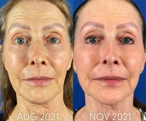 hybrid facial filler before and after photo 3