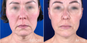 bella lift before and after treatment