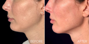 dermal filler before and after patient image - side profile