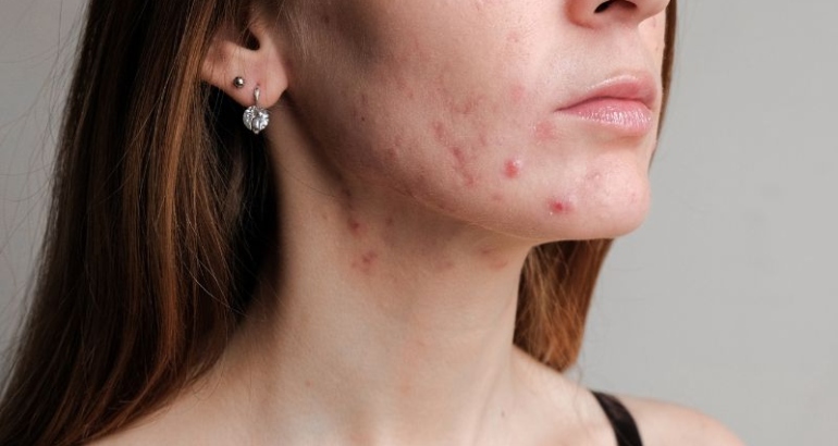 Ultimate Guide to Acne: Your Comprehensive Guide to Clearer Skin