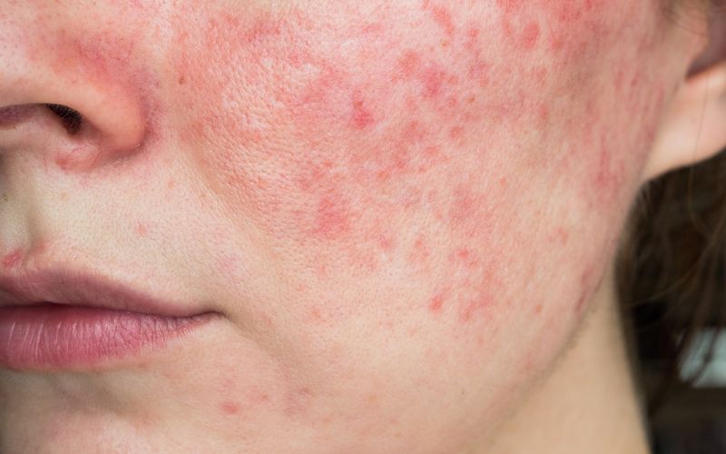 Ultimate Guide to Rosacea: How to Manage Your Skin Condition