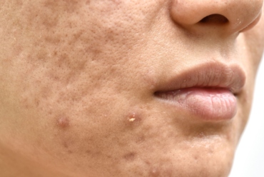 Everything You Need To Know About Acne Scarring