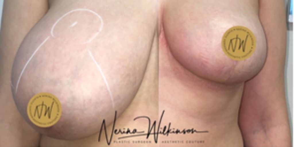 Breast reduction surgery results