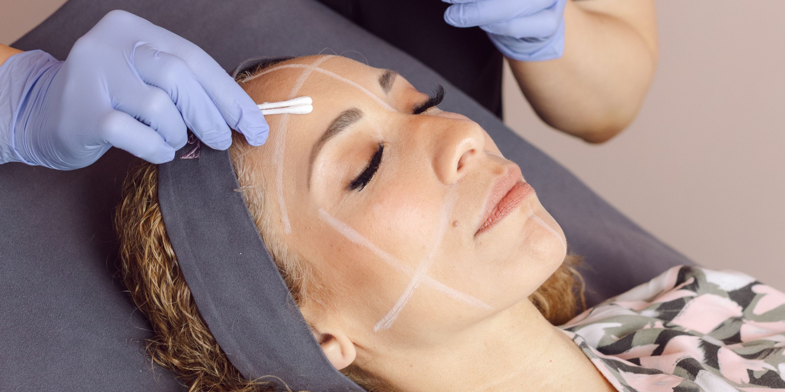 TCA chemical peel treatment at Dr Nerina Wilkinson and Associates