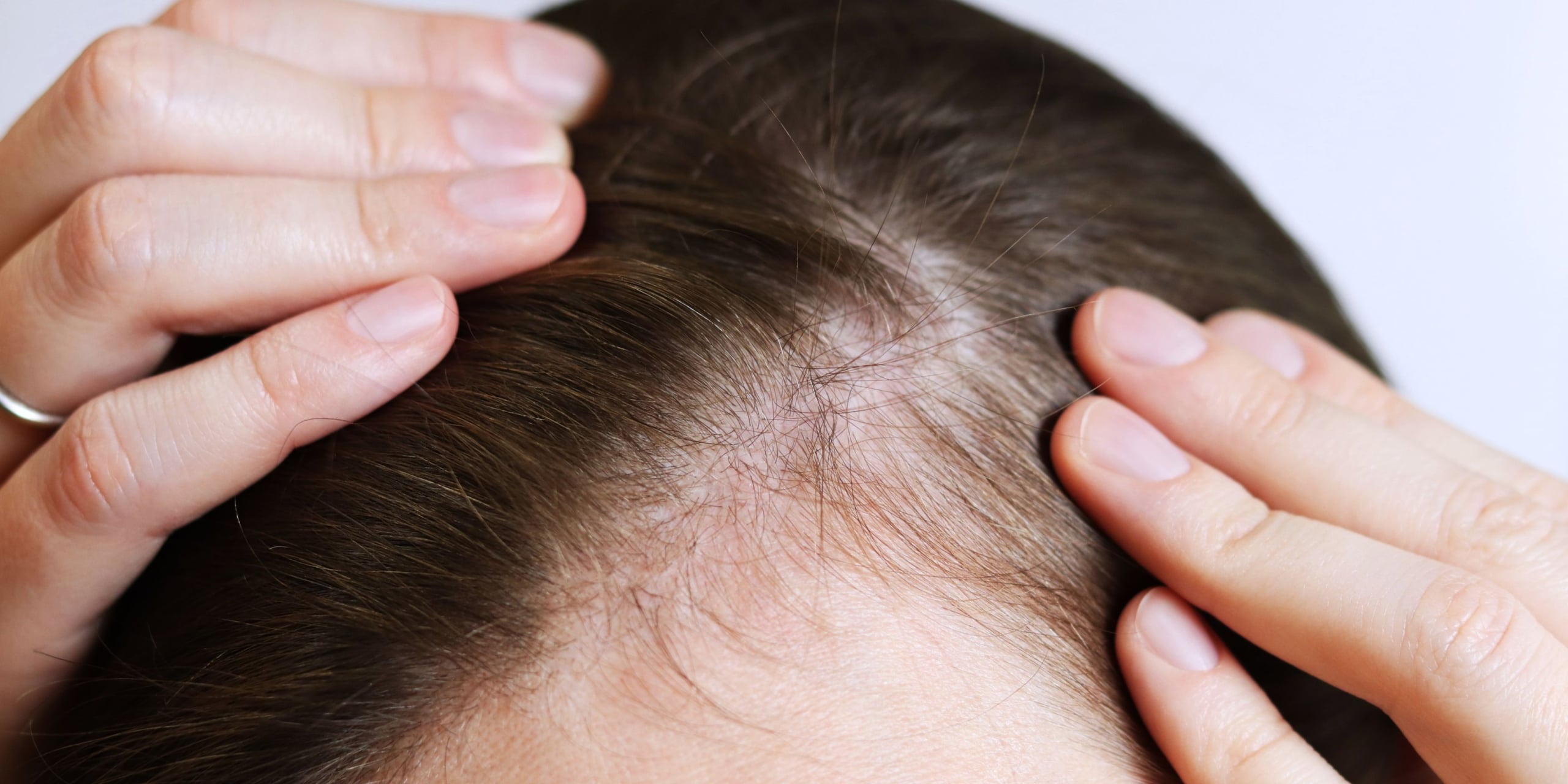 Woman showing her thinning hair
