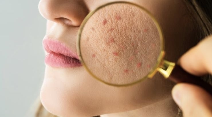 Skin Memory: How Past Sun, Stress & Acne Show Up Years Later