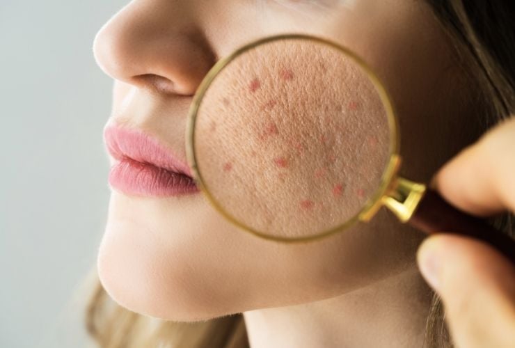Skin Memory: How Past Sun, Stress & Acne Show Up Years Later