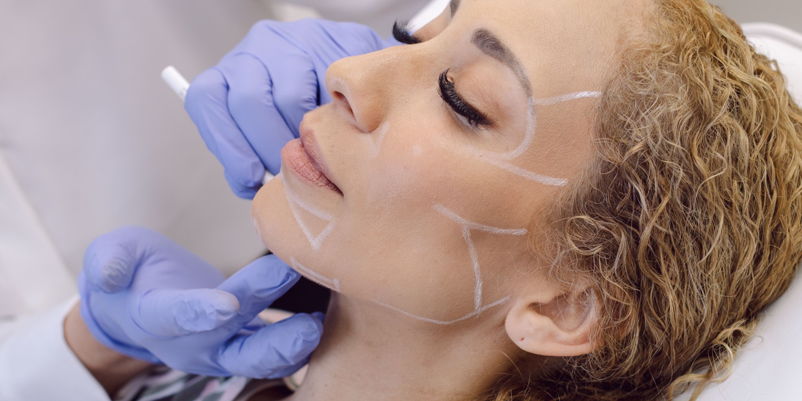 Facial markings for a signature N-Lift facial sculpting procedure