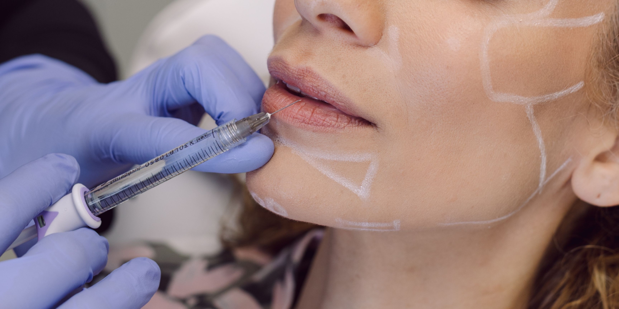 Woman getting dermal filler injections at Dr Nerina Wilkinson and Associates