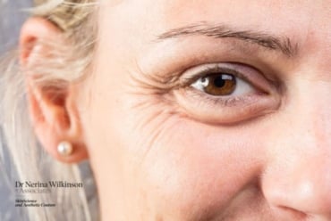 Wrinkles Don’t Cause Ageing: The Science Behind Facial Ageing