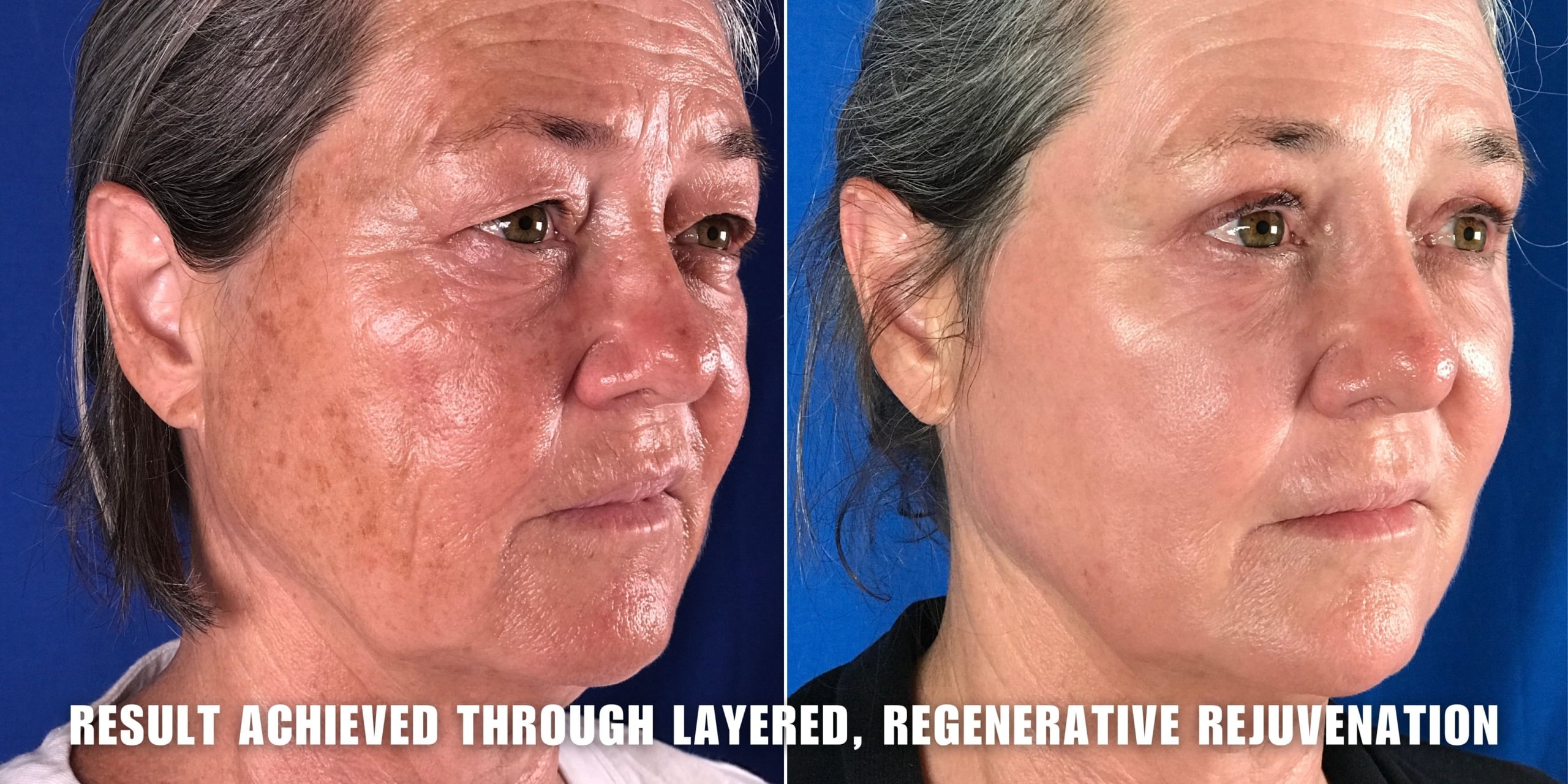 StemCell4DLift results achieved at Dr Nerina Wilkinson and Associates