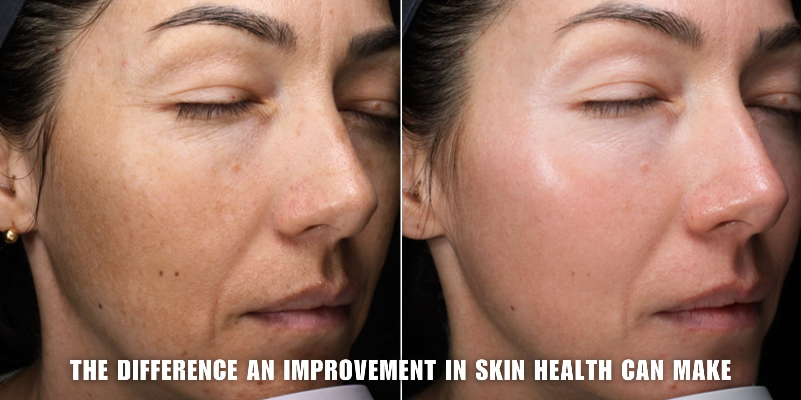 Skin brightening and smoothing results achieved at Dr Nerina Wilkinson and Associates